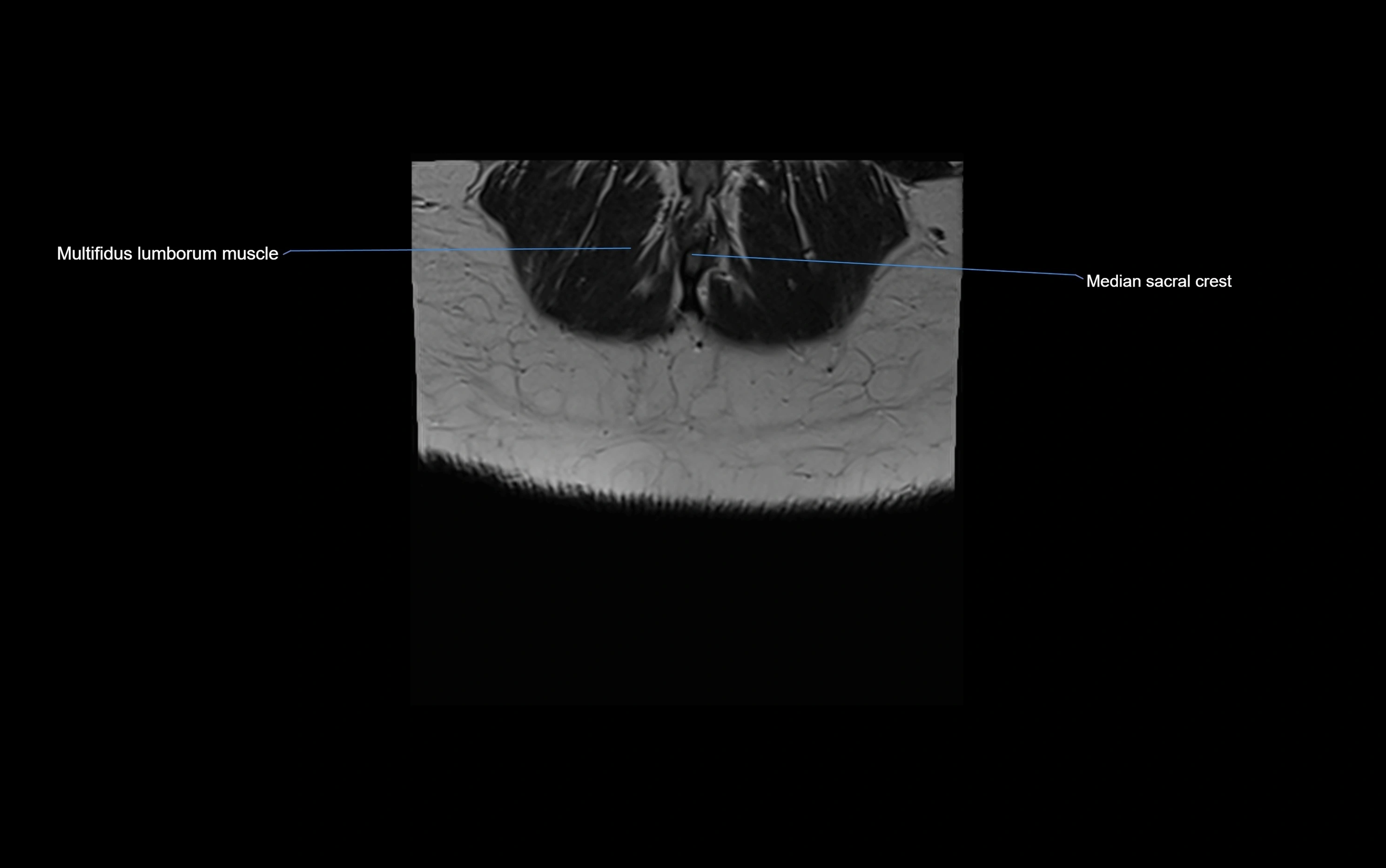 MRI sacroiliac joint coronal cross sectional anatomy  radiology  image-img-00001-00034.webp